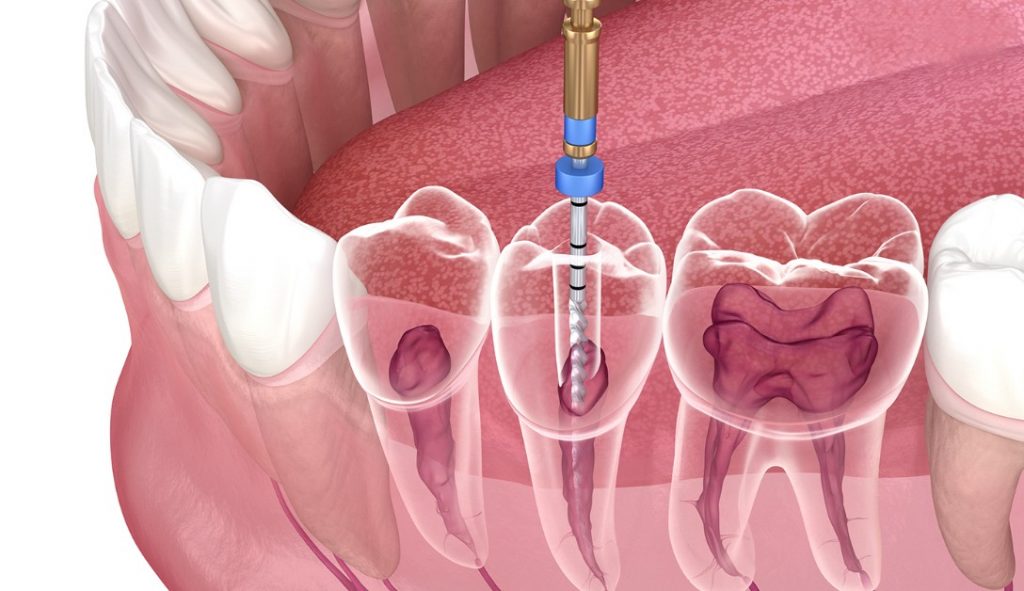 রুট ক্যানেল ট্রিটমেন্ট - Azam's Dental Care