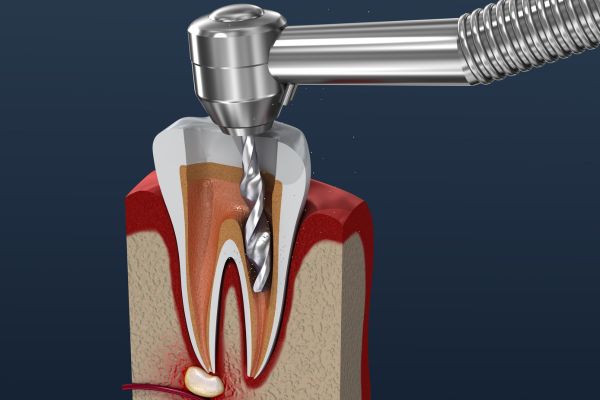 সার্জিক্যাল এন্ডোডন্টিক্স - Azam's Dental Care