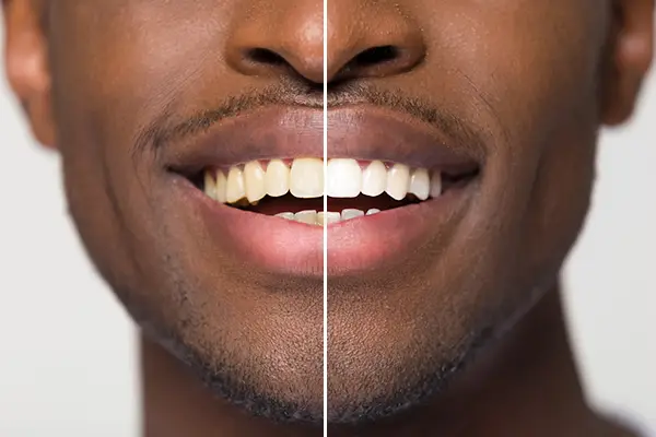 টুথ হোয়াইটেনিং (দাঁত সাদা করা) - Azam's Dental Care