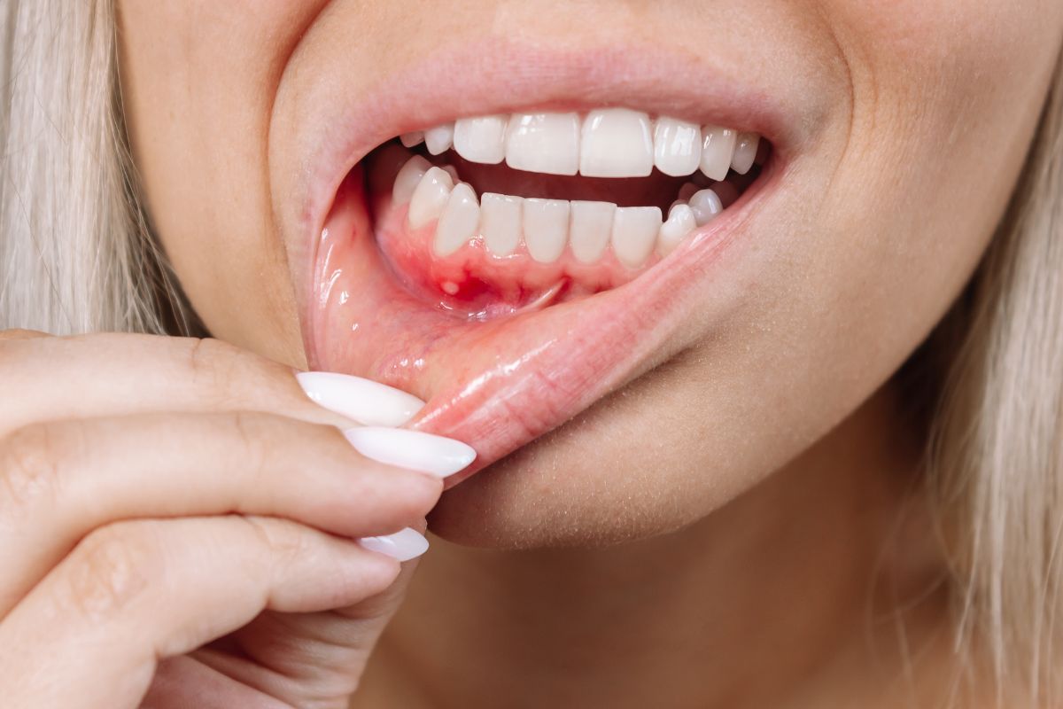 মুখ বা জিহ্বার আলসার এবং ওরাল সিস্টের চিকিৎসা - Azam's Dental Care